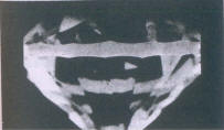 Fig 235 Very thick girdle 